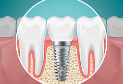 AN INSIGHT ON THE MUCH TALKED ABOUT PART OF DENTISTRY: THE IMPLANTS.