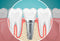 AN INSIGHT ON THE MUCH TALKED ABOUT PART OF DENTISTRY: THE IMPLANTS.