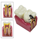 Dental Caries Comparison Study Model for Patient Education (6X Magnification)