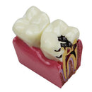 Dental Caries Comparison Study Model for Patient Education (6X Magnification)