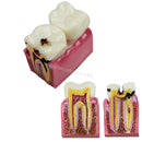 Dental Caries Comparison Study Model for Patient Education (6X Magnification)