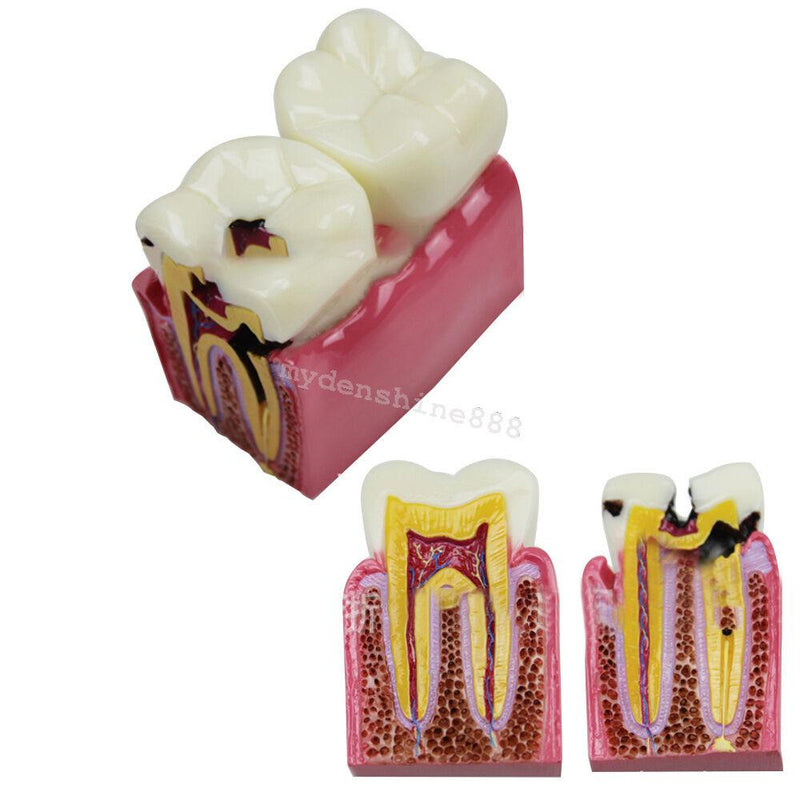 Dental Caries Comparison Study Model for Patient Education (6X Magnification)