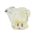 Complete Teeth Restoration Study with Dental Implant Model, Removable Bridge