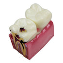 Dental Caries Comparison Study Model for Patient Education (6X Magnification)