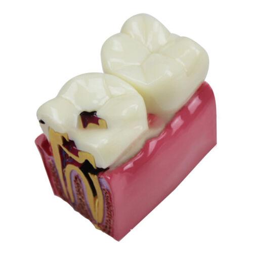 Dental Caries Comparison Study Model for Patient Education (6X Magnification)