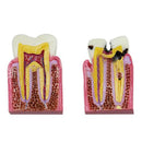 Dental Caries Comparison Study Model for Patient Education (6X Magnification)