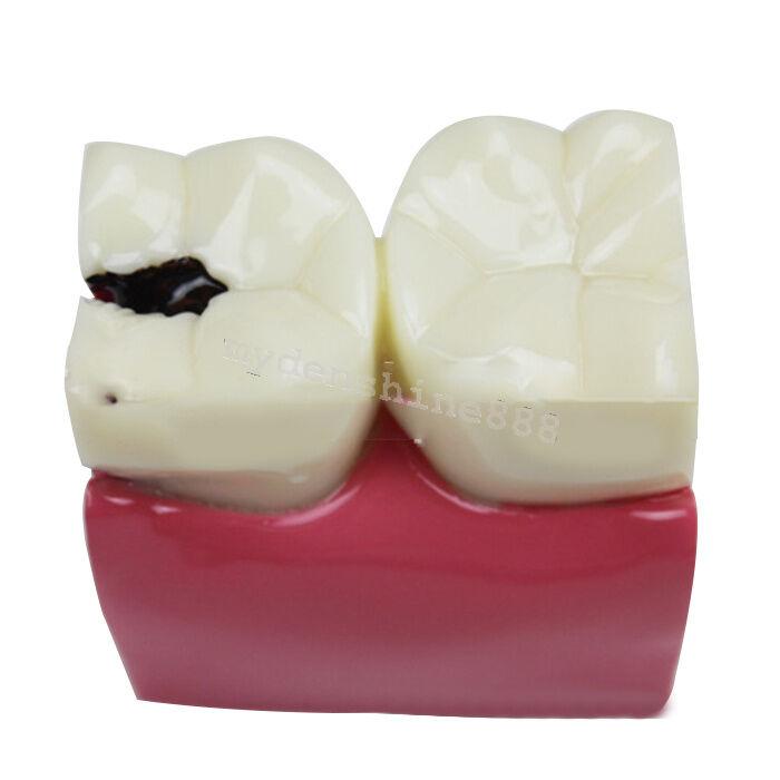 Dental Caries Comparison Study Model for Patient Education (6X Magnification)