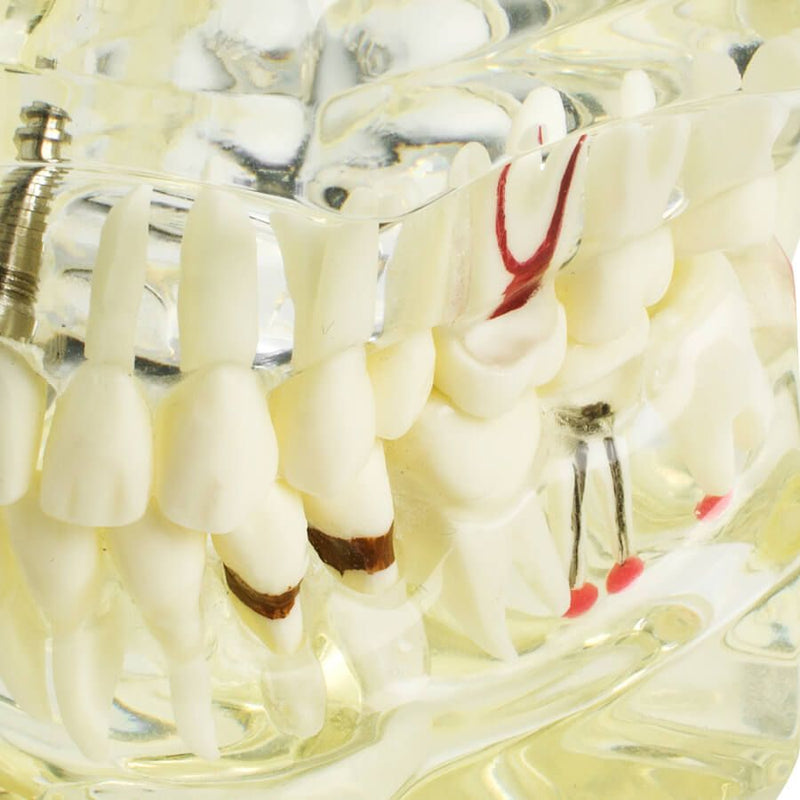1pc Dental Implant Disease Teeth Model with Restoration & Bridge Tooth