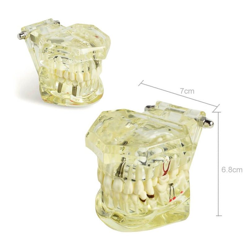 1pc Dental Implant Disease Teeth Model with Restoration & Bridge Tooth