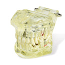 1pc Dental Implant Disease Teeth Model with Restoration & Bridge Tooth
