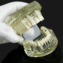 1pc Dental Implant Disease Teeth Model with Restoration & Bridge Tooth