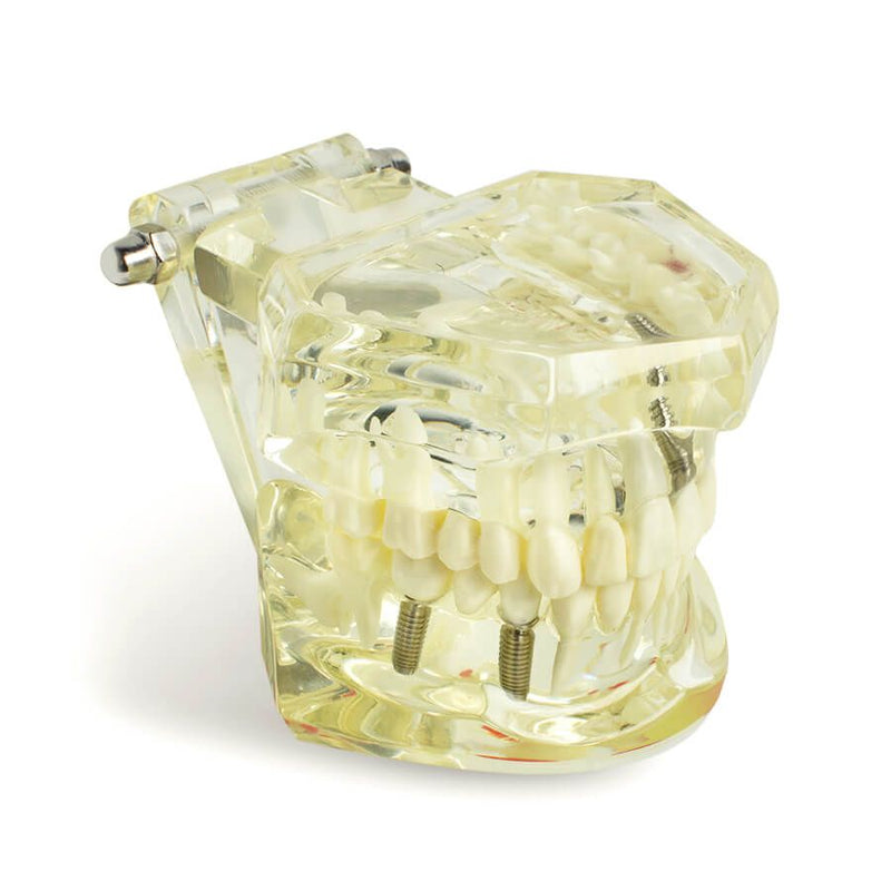 1pc Dental Implant Disease Teeth Model with Restoration & Bridge Tooth