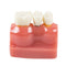 Dental Demonstration Teeth Model Implant Analysis Crown Bridge