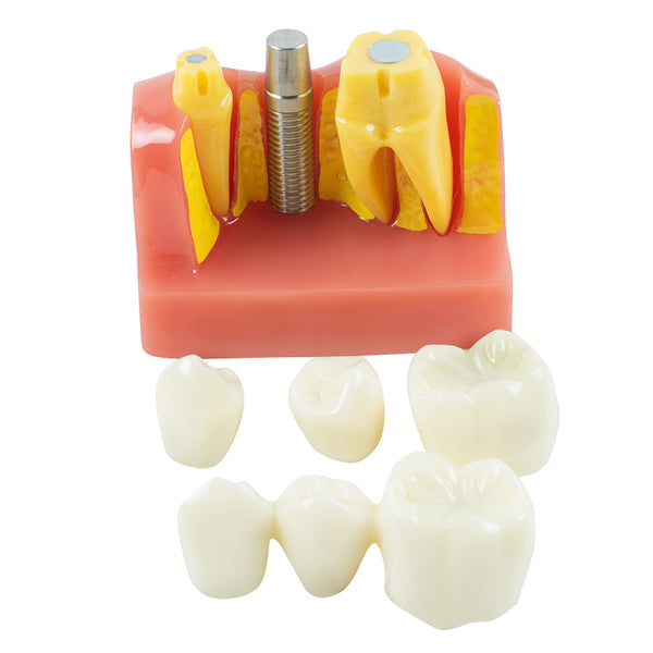 Dental Demonstration Teeth Model Implant Analysis Crown Bridge