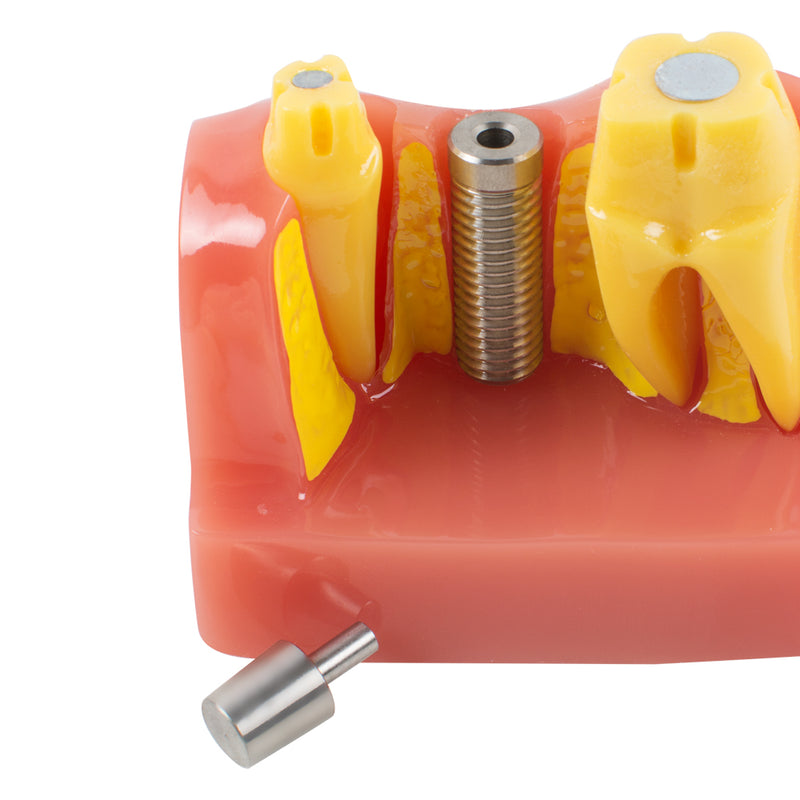 Dental Demonstration Teeth Model Implant Analysis Crown Bridge