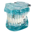 Dental Study Tooth Transparent Adult Pathological Teeth Model