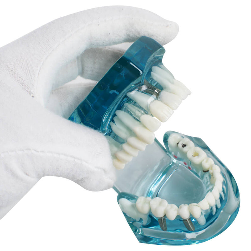 Dental Study Tooth Transparent Adult Pathological Teeth Model