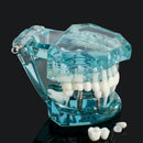 Dental Study Tooth Transparent Adult Pathological Teeth Model