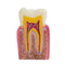 Dental Patient Education Teeth Model 6 Times Caries Comparation Study Model