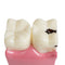 Dental Patient Education Teeth Model 6 Times Caries Comparation Study Model