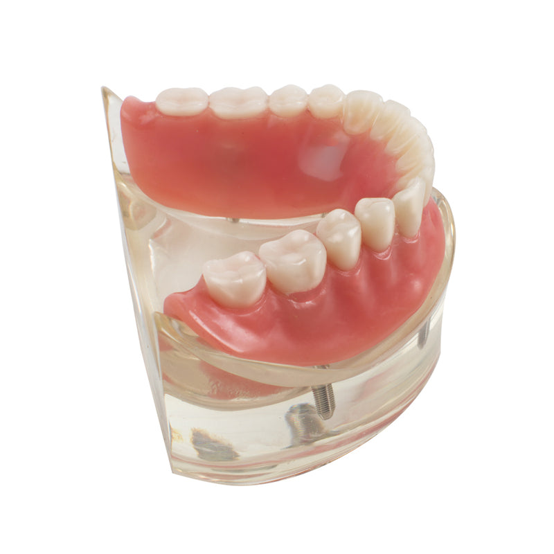 Dental Model Overdenture Inferior 2 Implants Restroration Study