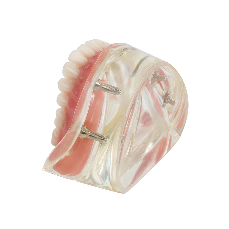 Dental Model Overdenture Inferior 2 Implants Restroration Study