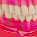 Dental Teeth Model Teach Study Oral Implant Restoration & Pathology