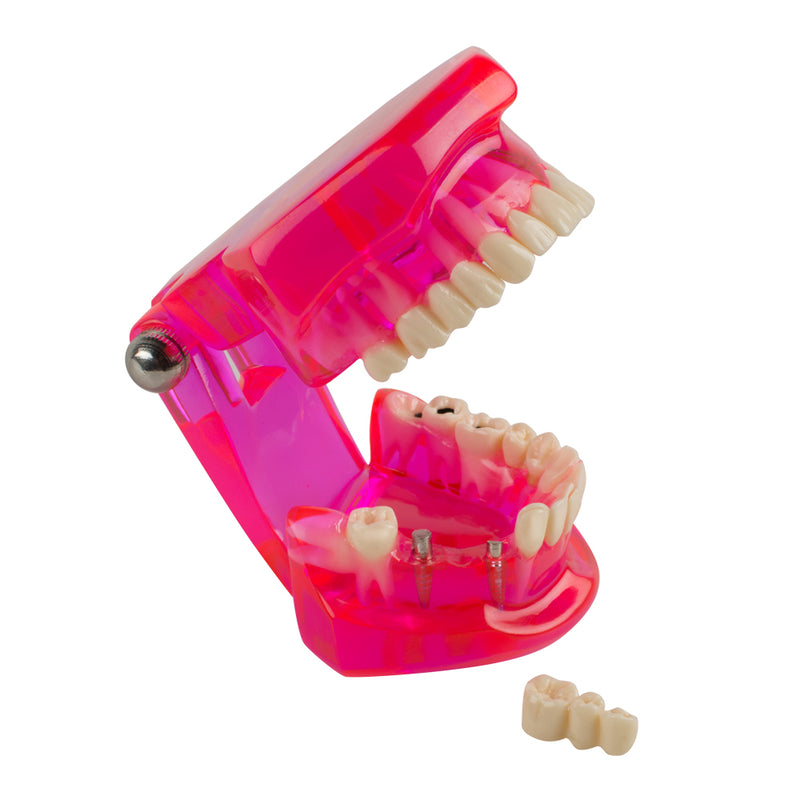 Dental Teeth Model Teach Study Oral Implant Restoration & Pathology