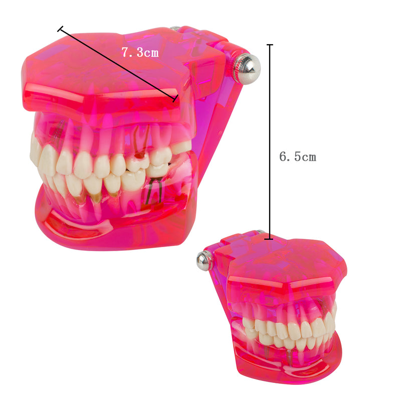 Dental Teeth Model Teach Study Oral Implant Restoration & Pathology