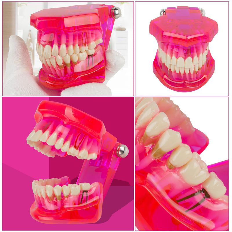 Dental Teeth Model Teach Study Oral Implant Restoration & Pathology
