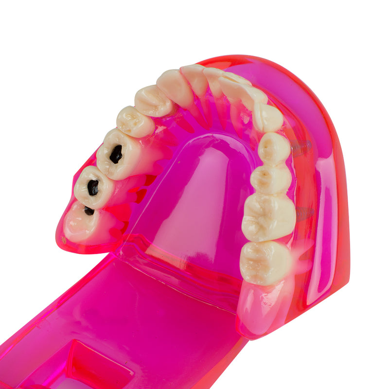 Dental Teeth Model Teach Study Oral Implant Restoration & Pathology